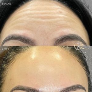 Botox - 7Q Spa & Laser Aesthetics - Glendale, CA