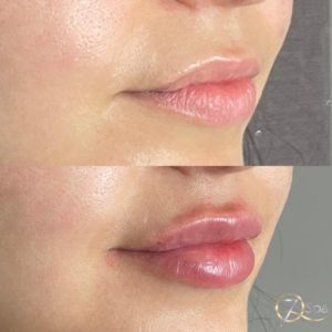 Lip Filler - 7Q Spa & Laser Aesthetics - Glendale, CA