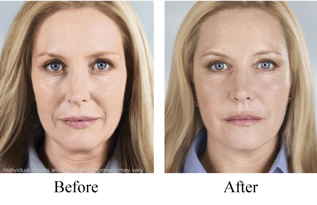 Sculptra Aesthetic - Glendale, CA - 7Q Spa