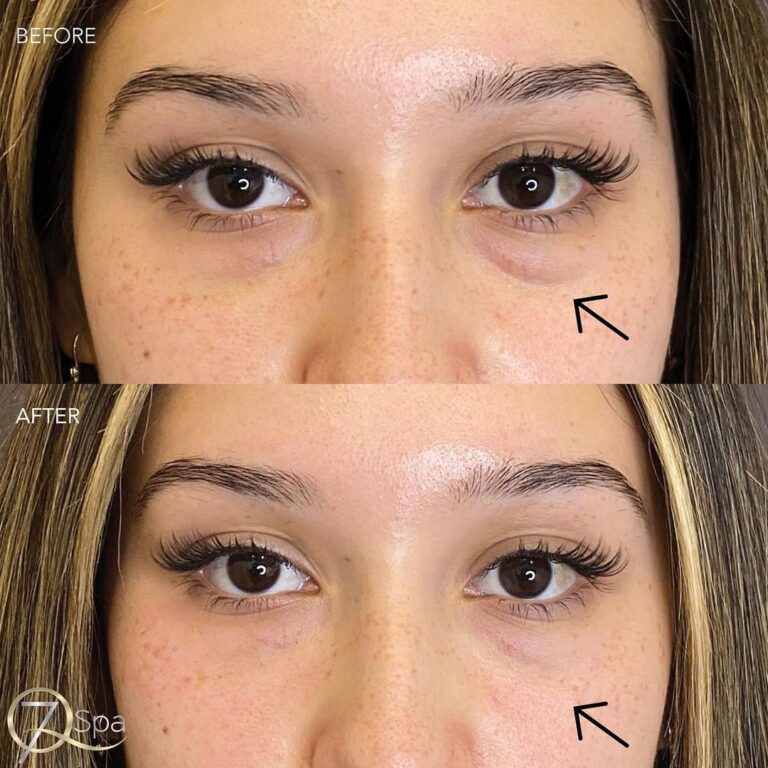 Under Eye Filler - 7Q Spa - Glendale, CA